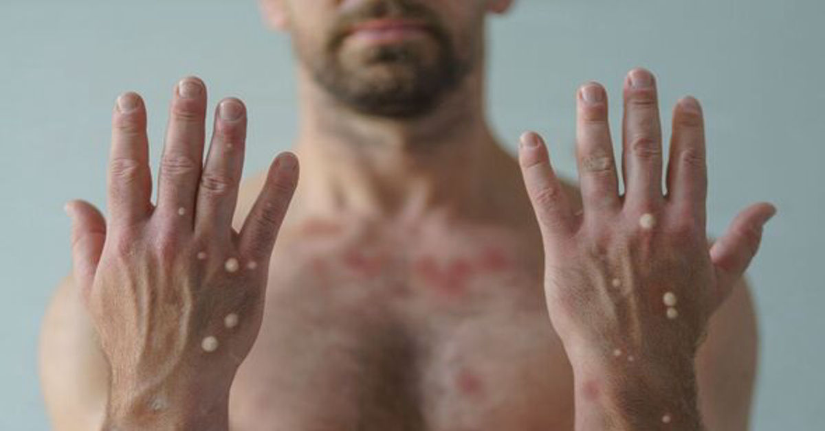MonkeyPox